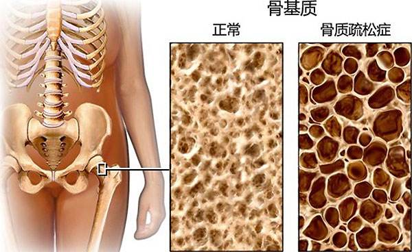 骨質(zhì)健康問題.jpg