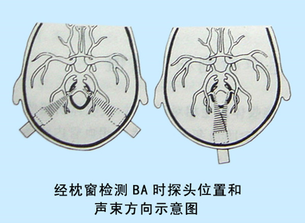 04經(jīng)枕窗檢測BA時探頭位置和聲束方向示意圖.jpg