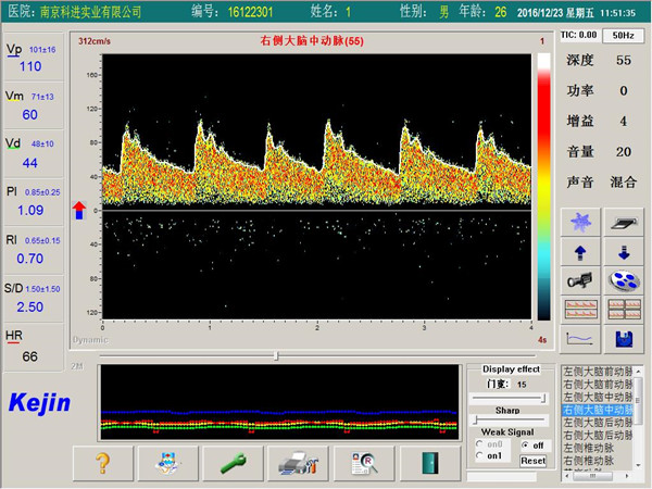 超聲經(jīng)顱多普勒血流分析儀檢測(cè)界面.jpg