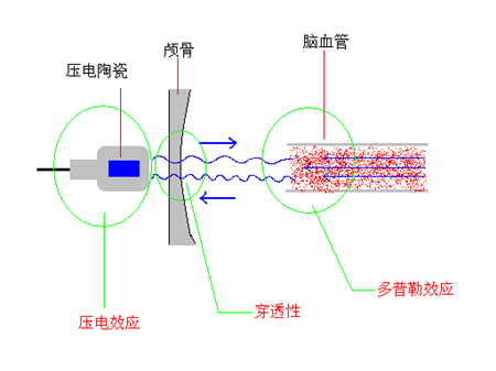 腦彩超儀（TCD儀）的原理