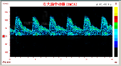 腦動(dòng)脈硬化.jpg