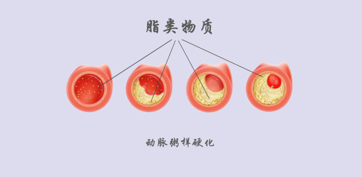 腦動(dòng)脈粥樣硬化是什么意思 怎么形成的